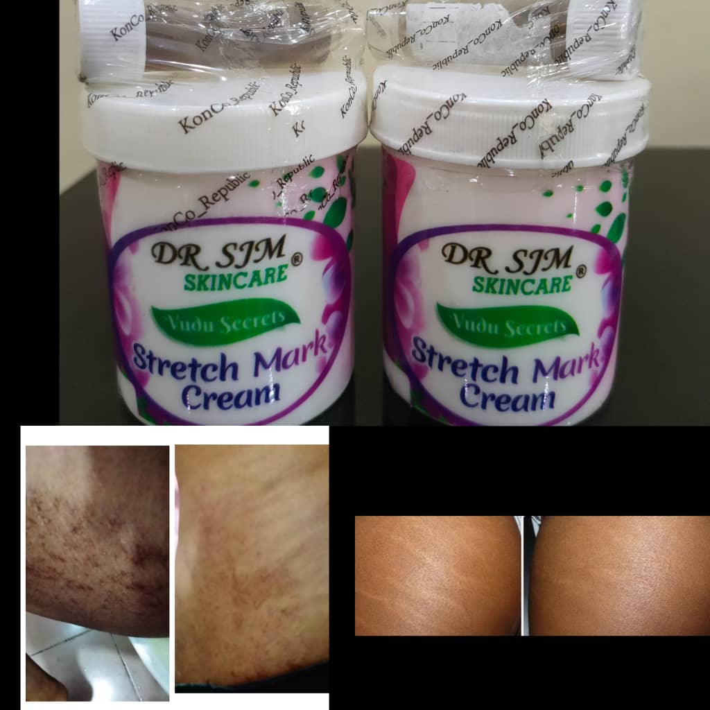 Stretch marks remover